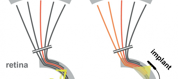 Improvement in the resolution of Retinal Prostheses